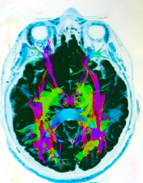 A brain scan illustration highlighting the areas activated during gratitude practices, such as the prefrontal cortex and the amygdala.